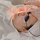 IPL Skin Rejuvenation 