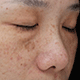 De pigmentation