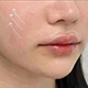 RF Facial Enhancement 